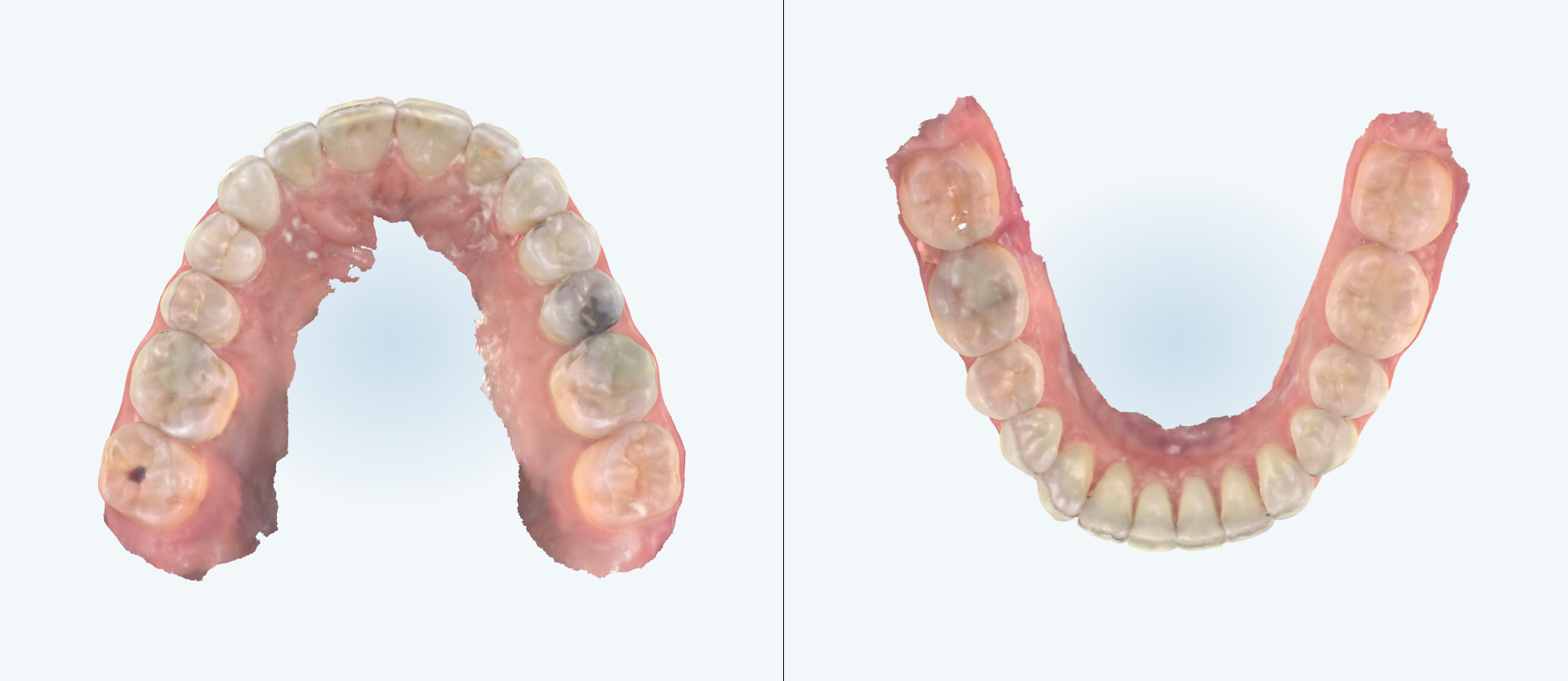 Dental expansion treatment comparison case 3 after
